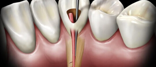 traitement endodontique