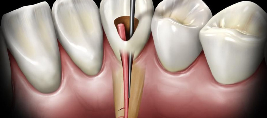 traitement endodontique